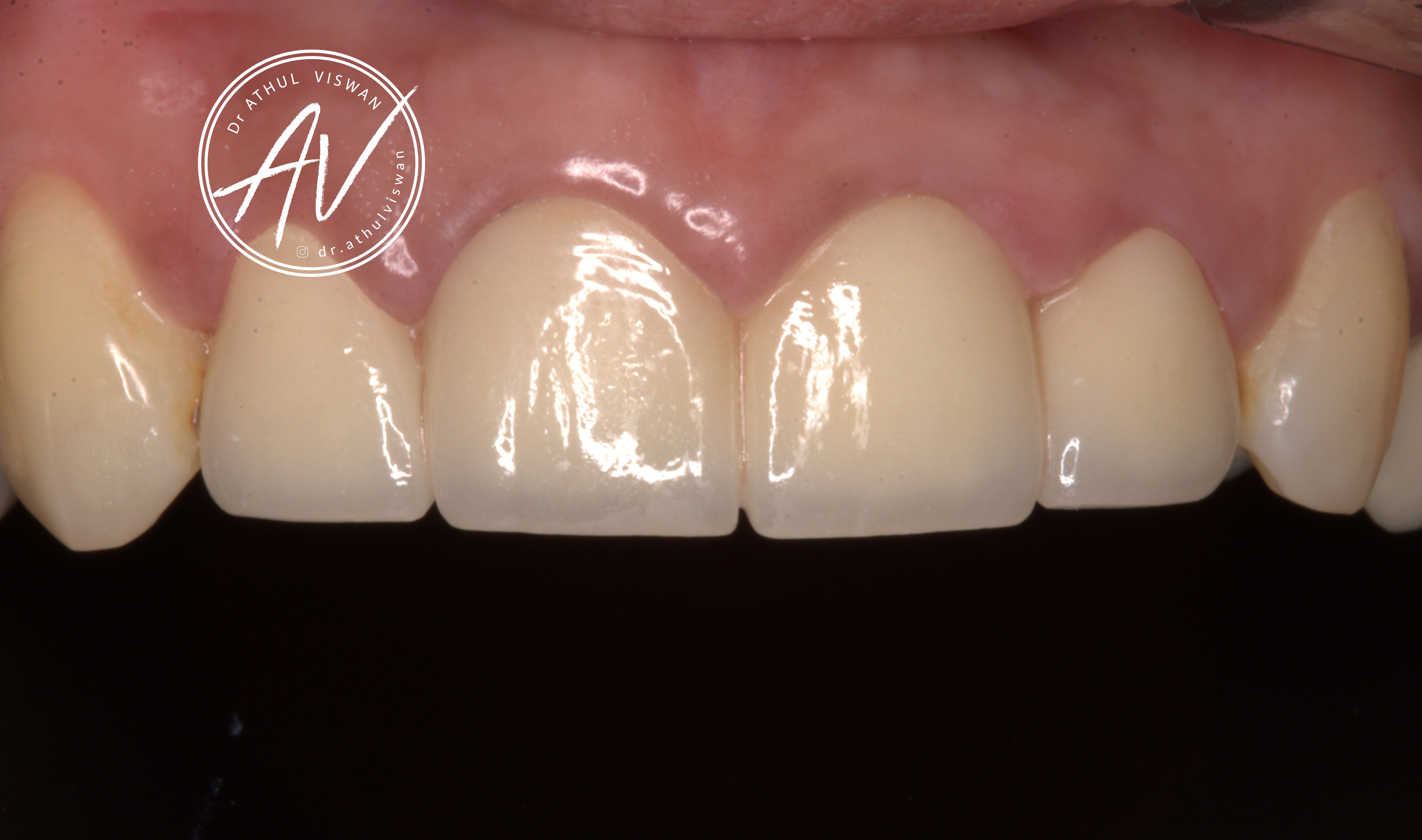 After Smile Designing